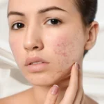 7 Best Acne Pimple Treatment Services in Kolkata