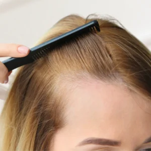 Best Hair Fall Treatment in Kolkata