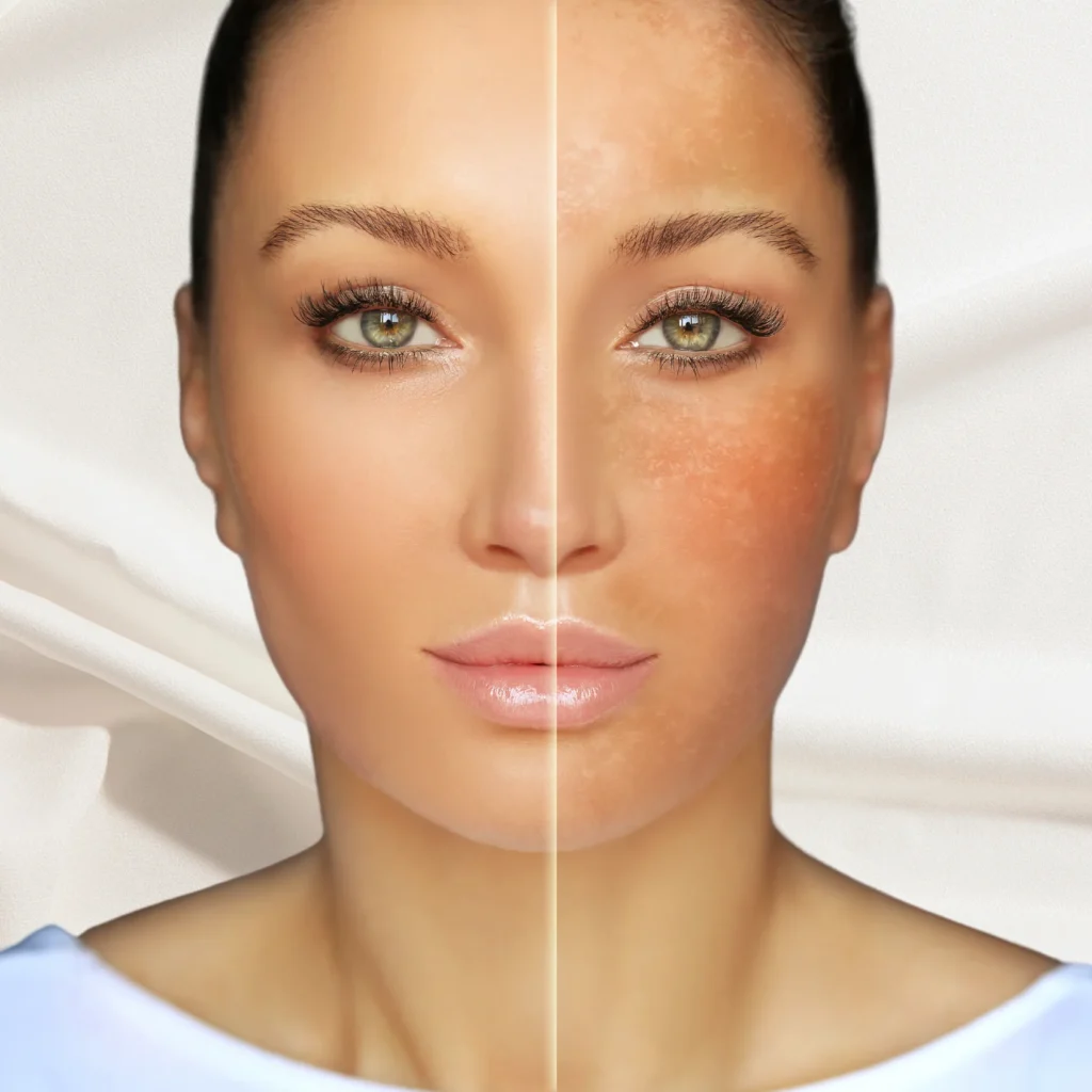 Melasma Treatment