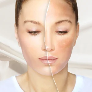 skin whitening treatments