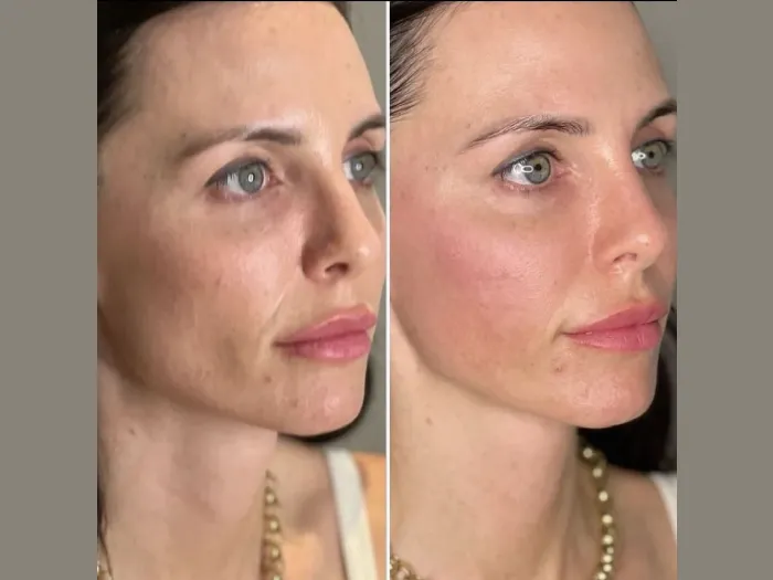 H1 Filorga NCTF Treatment